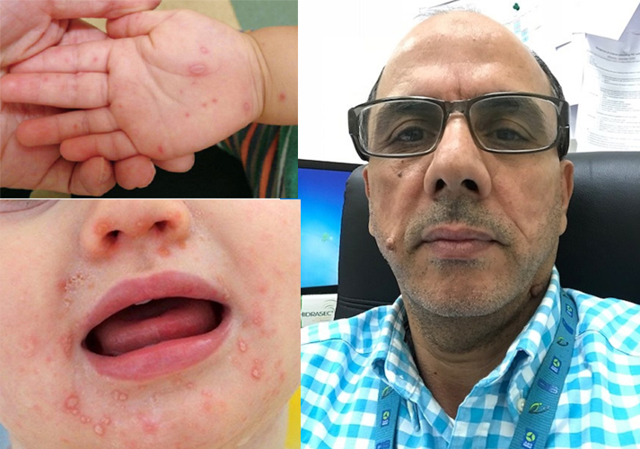 HMC Pediatrician Offers Tips for Preventing Hand, Foot, and Mouth Disease